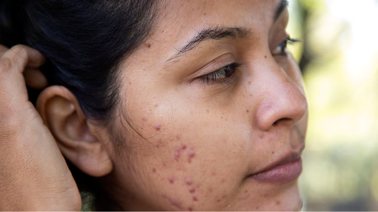 What Causes Dark Spots on Face Tang?